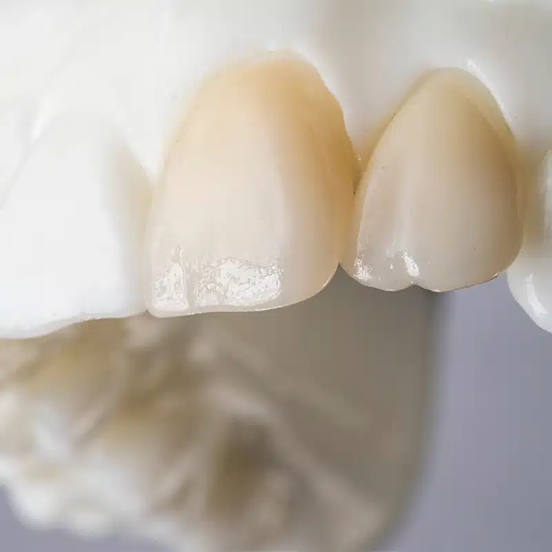 E.max® pressée ou E.max® usinée : quelle différence ?