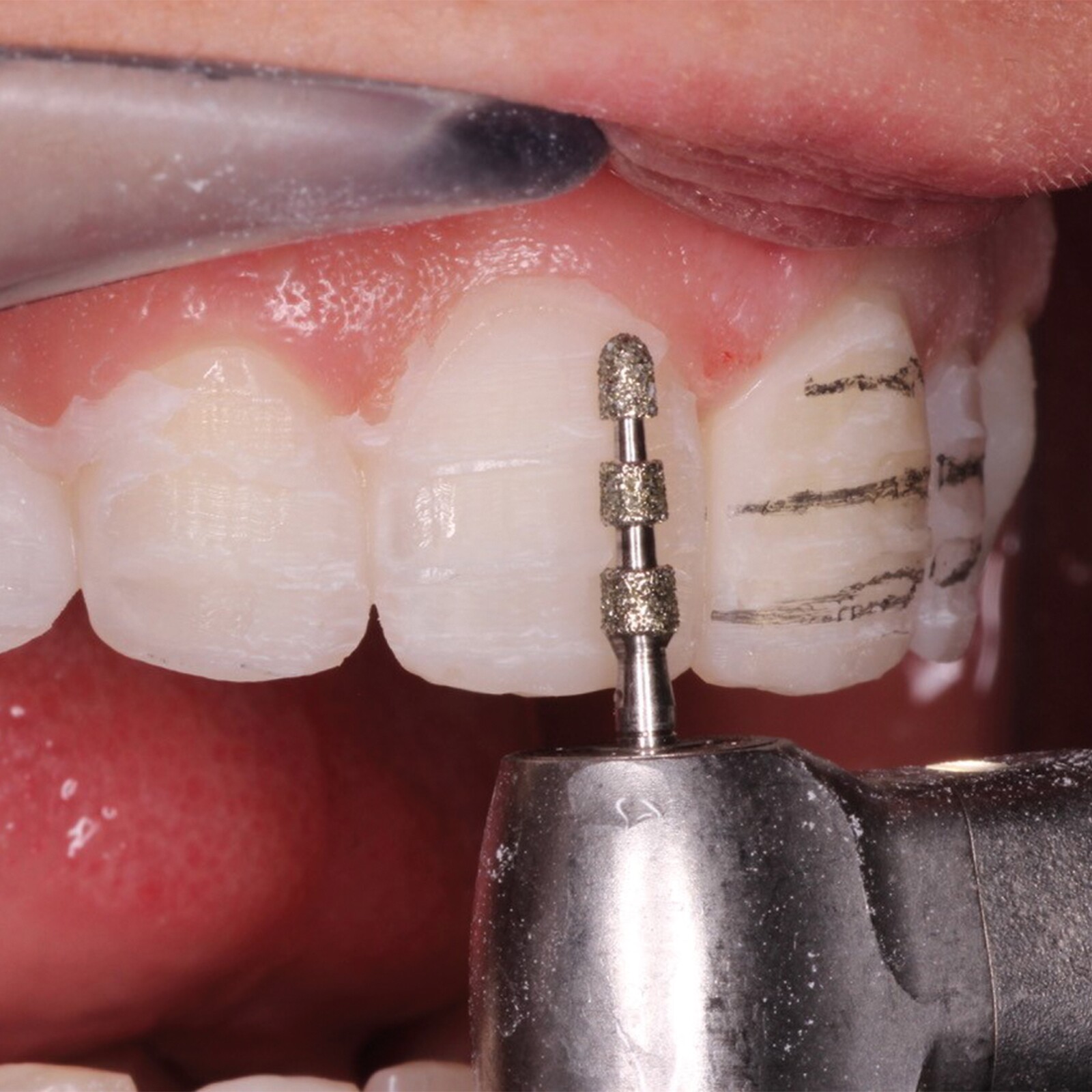 Pourquoi le collage est-il indispensable avec l’E.max® ?