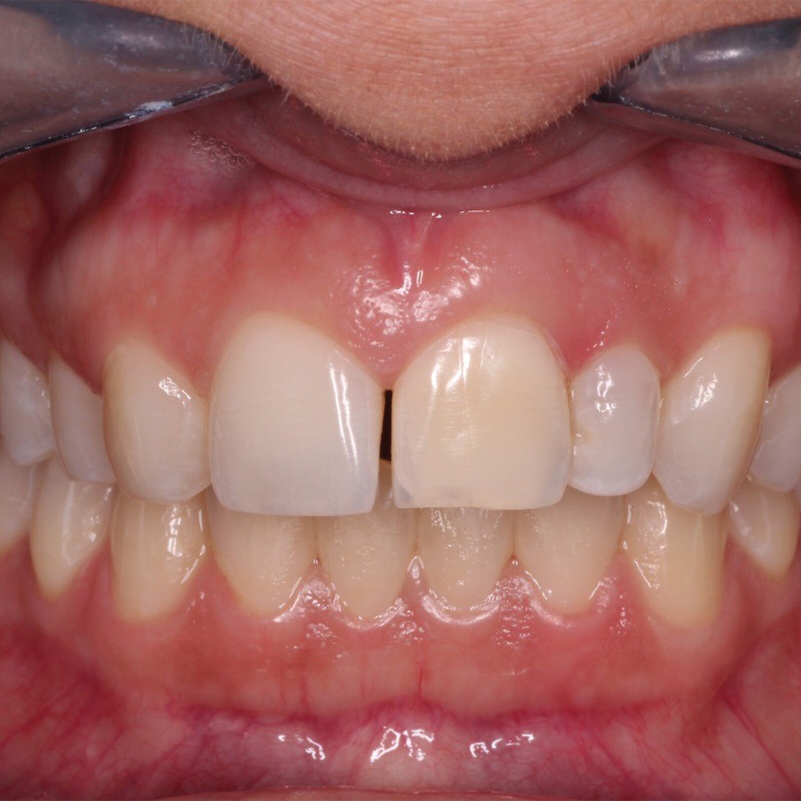 Quelle place occupe l’E.max® dans une stratégie prothétique moderne ?