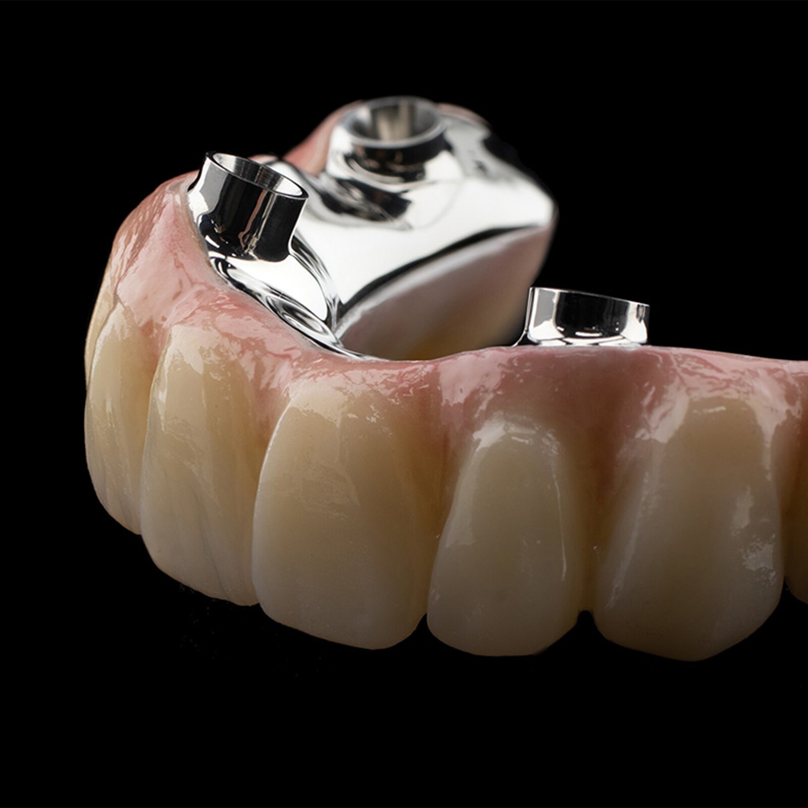 Les couronnes céramo-métalliques (CCM)