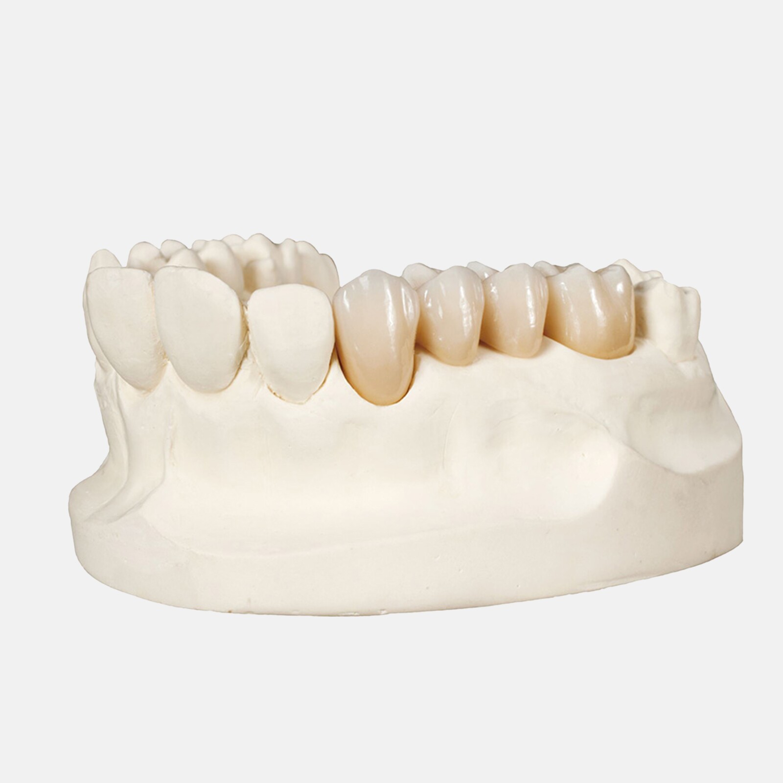 Les couronnes en zircone