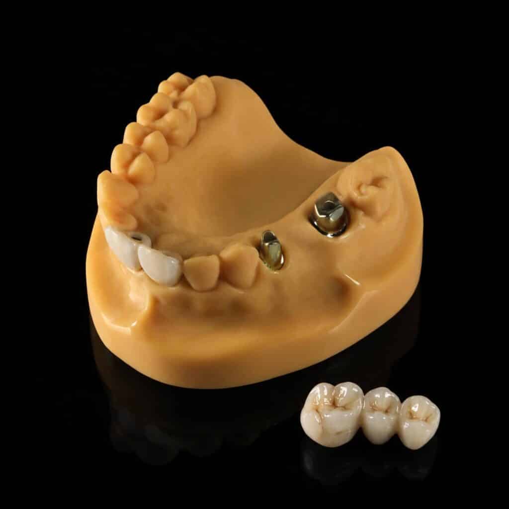 set up 1600 px crown and bridges 3 min