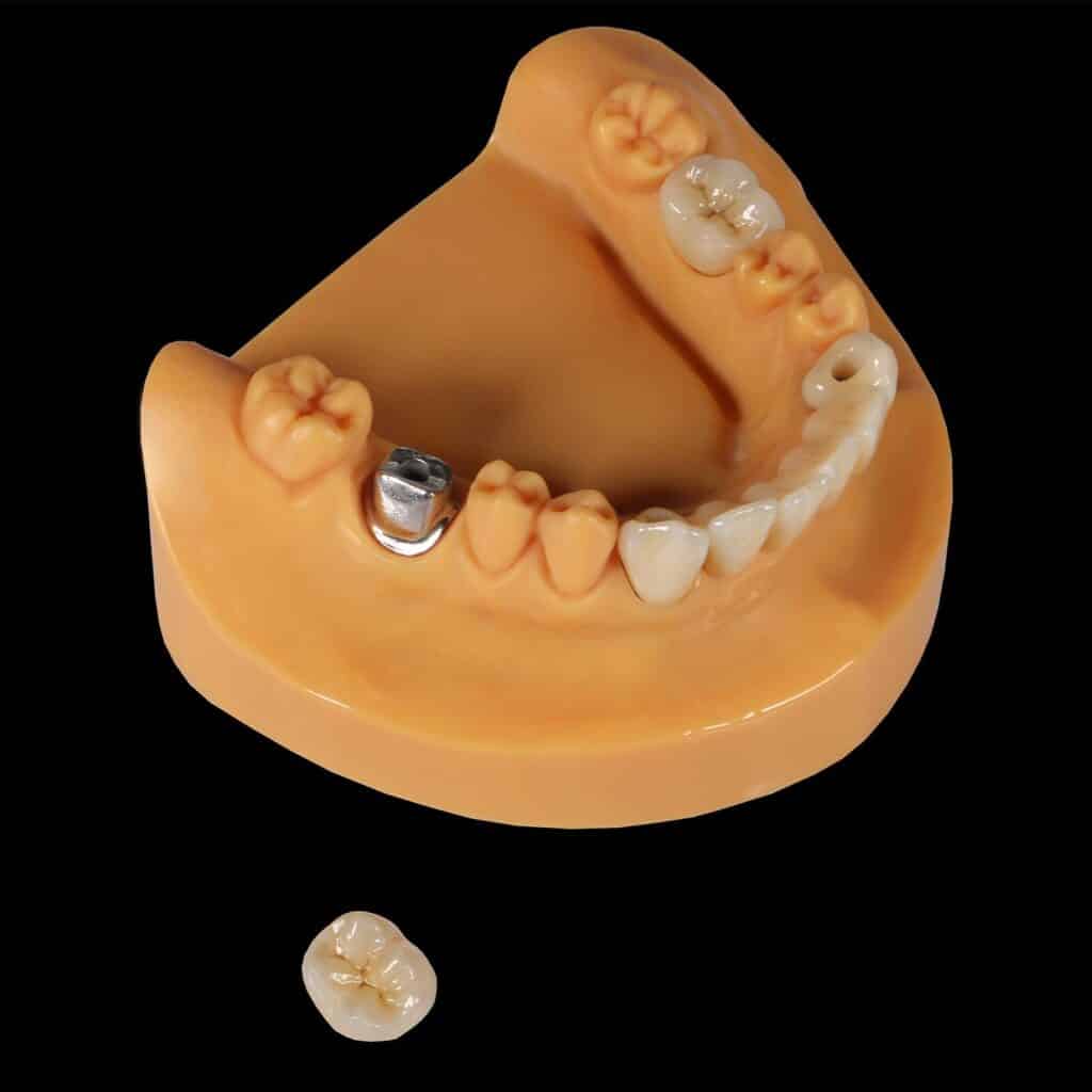 set up 1600 px crown and bridges 6 min